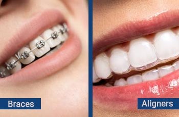 Best Braces and aligners Clinic in Nangloi