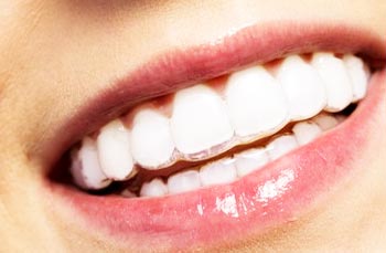 Best Clear Aligners Clinic in Nangloi