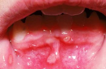 Best Mouth Ulcers Clinic in Nangloi