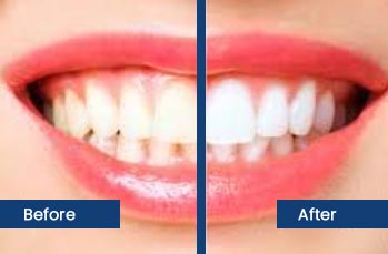 Best Teeth Whitening Clinic in Nangloi