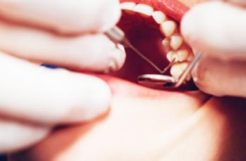 Best Wisdom Tooth Removal Clinic in Nangloi